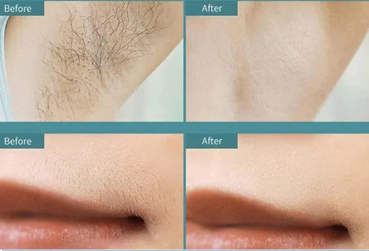 Epilateur Laser pour femmes